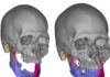 Planeación virtual, impresión 3D y prótesis a la medida precisión en cirugía maxilofacial en el IMSS